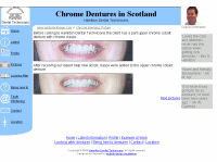 Chrome Dentures in Scotland
